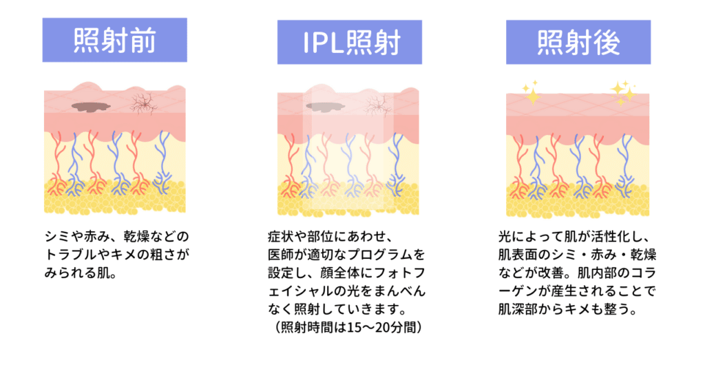 フォトフェイシャルの説明画像